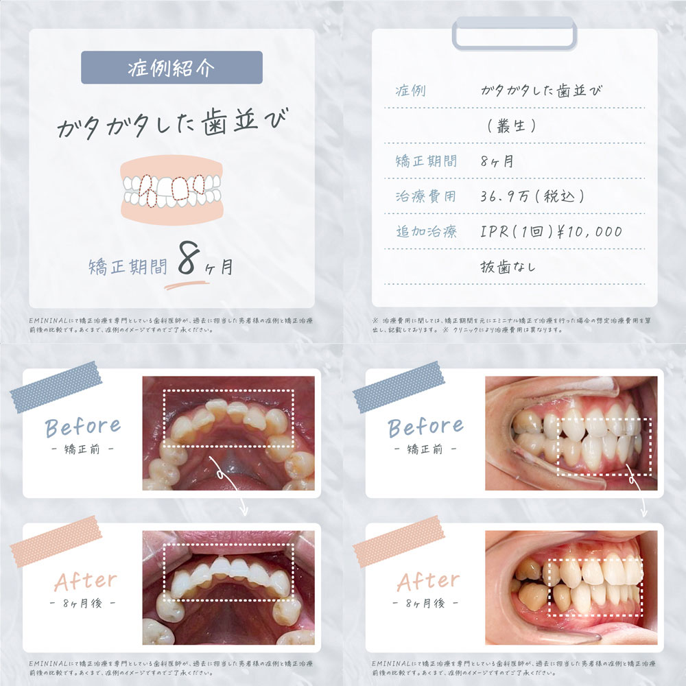 歯科矯正の症例：ガタガタの歯並び（矯正期間：8ヶ月）