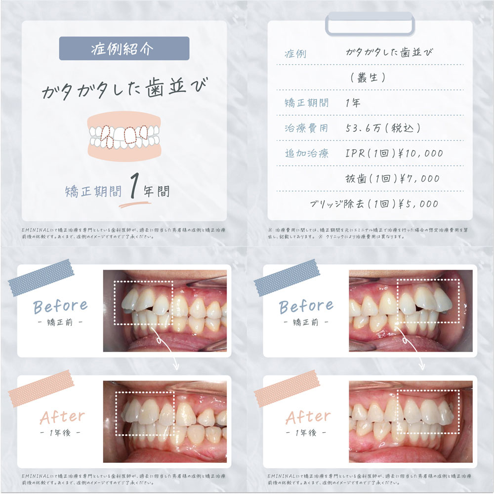 歯科矯正の症例:ガタガタの歯並び(矯正期間:1年)