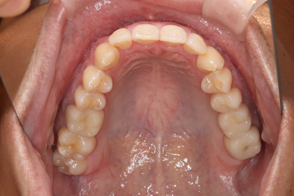 マウスピース型矯正装置での矯正治療