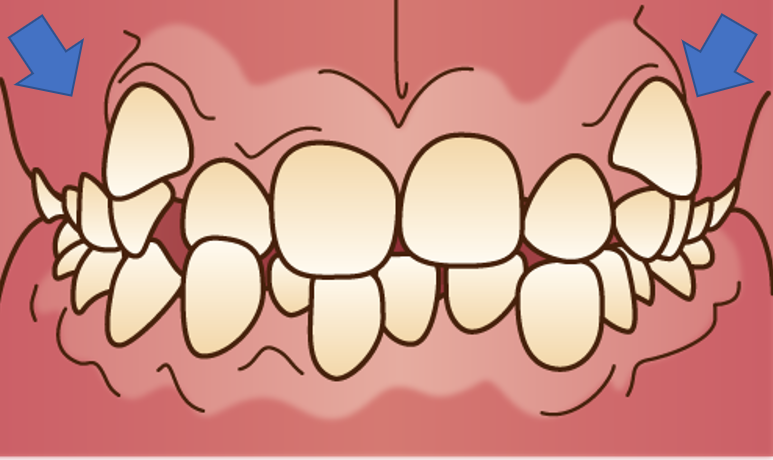 どうして八重歯になるの？八重歯は歯の生える順番と関係しています！