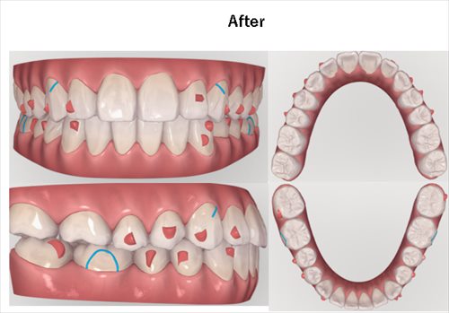 マウスピース型矯正装置(インビザライン)のシュミレーション（診断時）