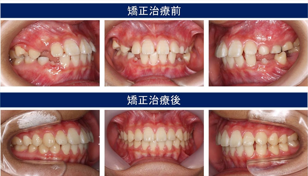 子供の出っ歯の矯正治療例 千葉県柏市で歯列矯正なら柏kt矯正歯科