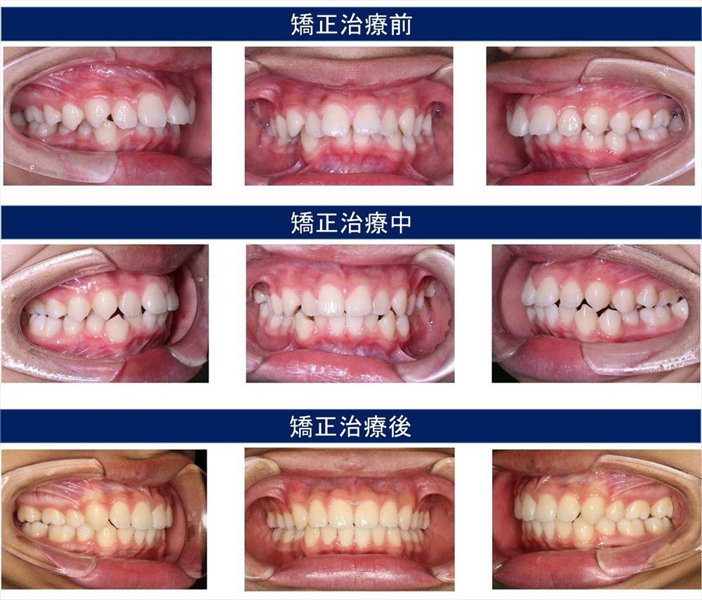 子供の出っ歯の治療例