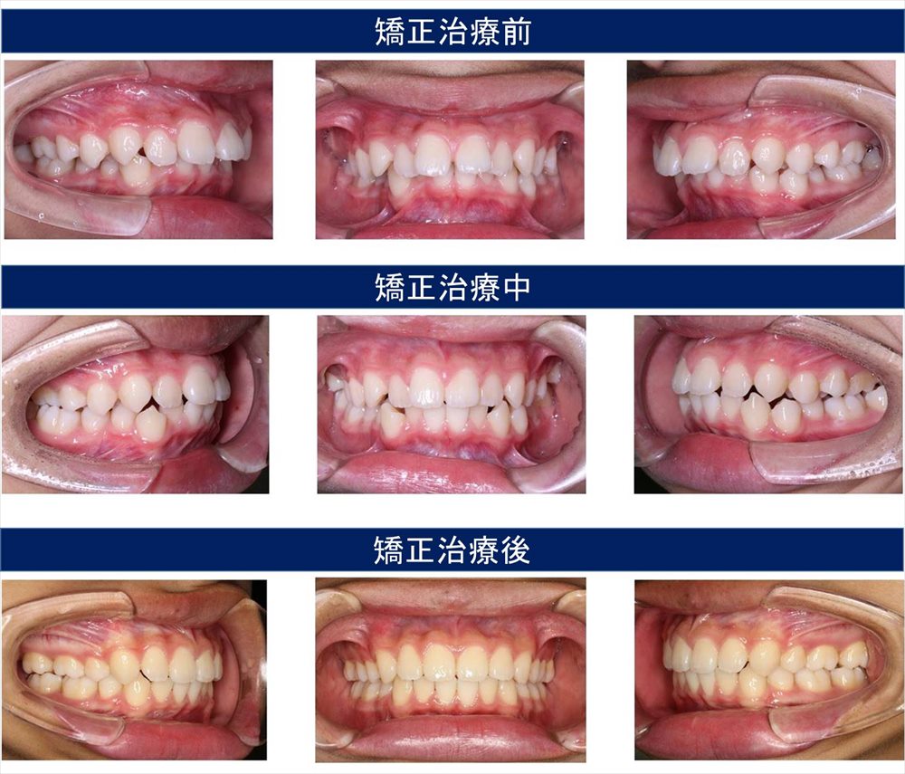 子供の出っ歯の矯正治療例 千葉県柏市で歯列矯正なら柏kt矯正歯科