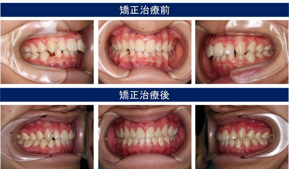 子供の出っ歯の治療例