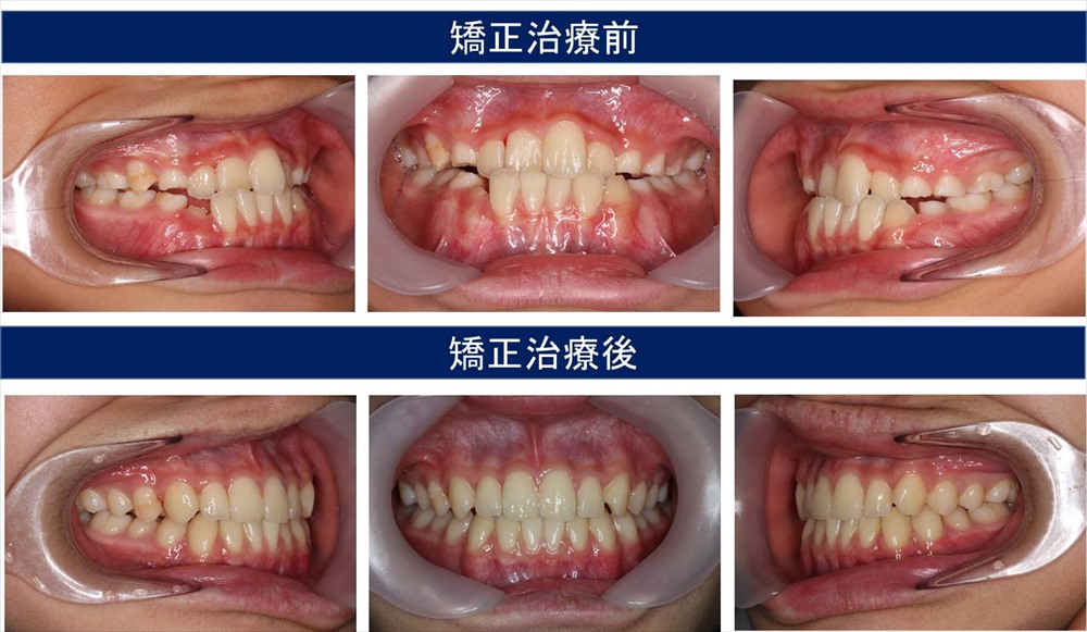 子供の反対咬合の治療例