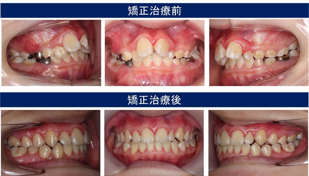 子供の八重歯・叢生の治療例