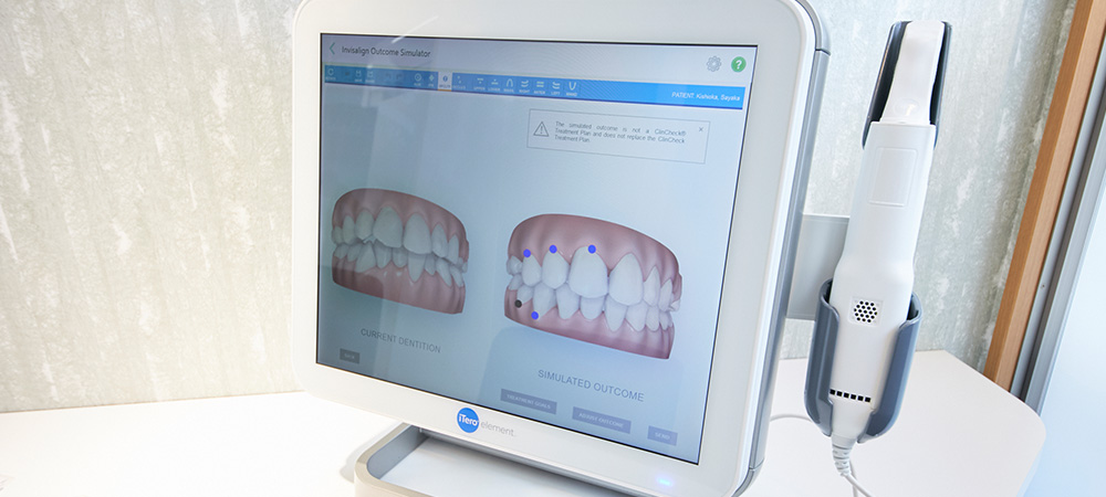 口腔内3Dスキャナー（iTero）