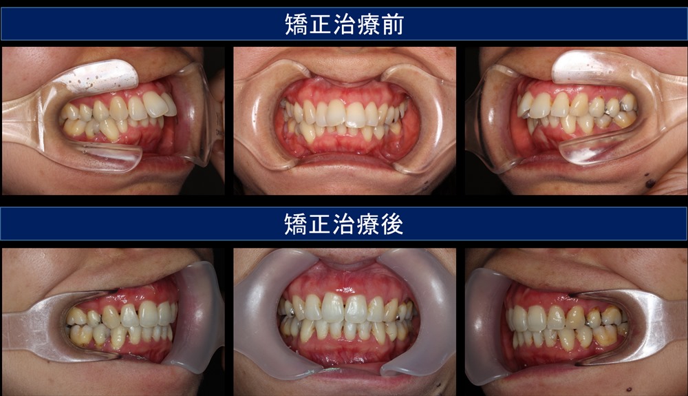 出っ歯（上顎前突）の治療例