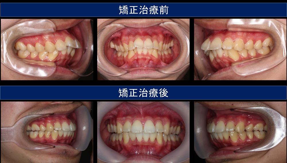 出っ歯（上顎前突）の治療例