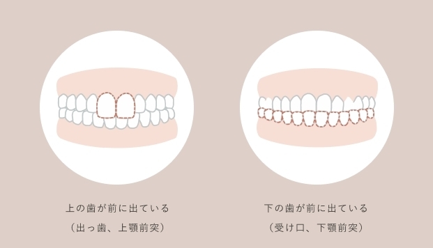 美人の秘訣はeライン 美容整形や歯科矯正で抜歯せず口ゴボを治す方法 千葉県柏市で歯列矯正なら柏kt矯正歯科