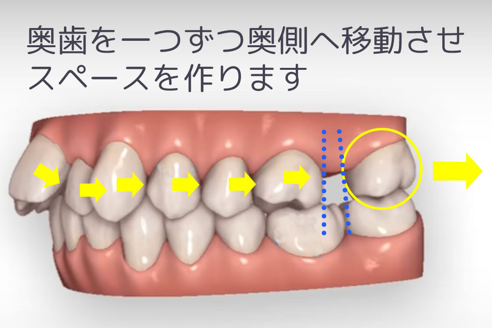 歯を遠心移動させる