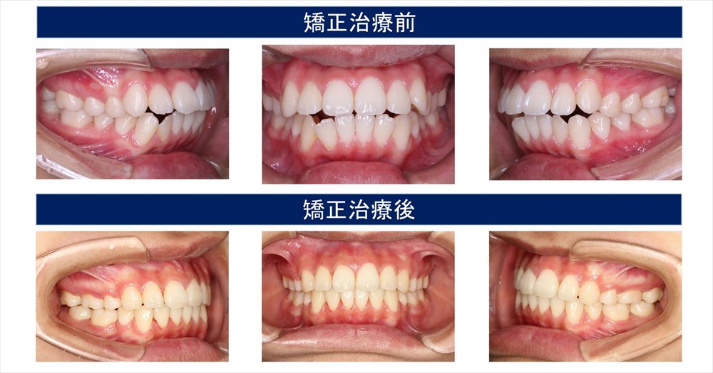 開咬（前歯が開く）の治療例
