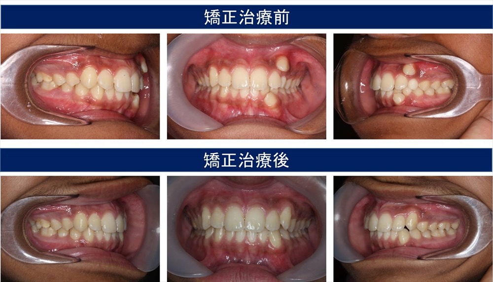 部分矯正(部分矯正)の治療例