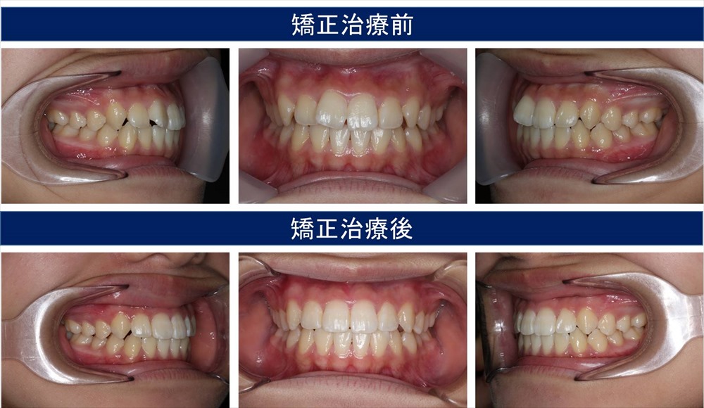 部分矯正(部分矯正)の治療例