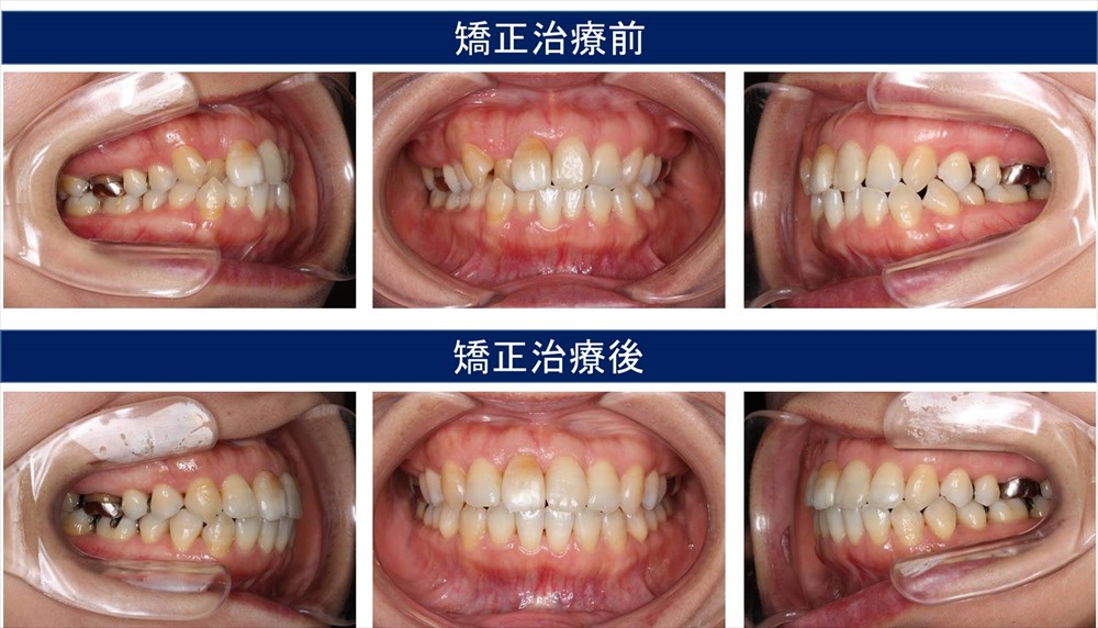 八重歯 叢生の歯科矯正治療例 千葉県柏市で歯列矯正なら柏kt矯正歯科