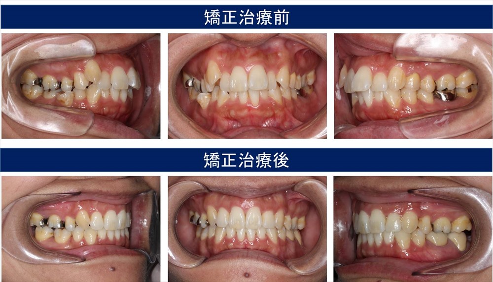 八重歯・叢生（凸凹の歯並び）の治療例