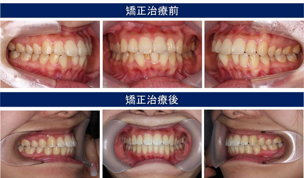 八重歯・叢生（凸凹の歯並び）の治療例