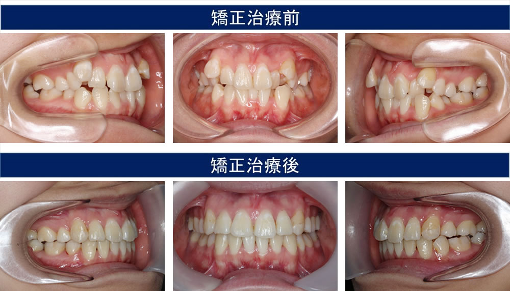 八重歯・叢生（凸凹の歯並び）の治療例
