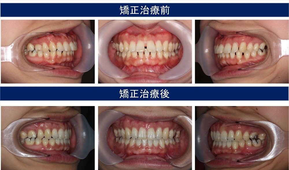 すきっ歯の歯科矯正治療例 千葉県柏市で歯列矯正なら柏kt矯正歯科