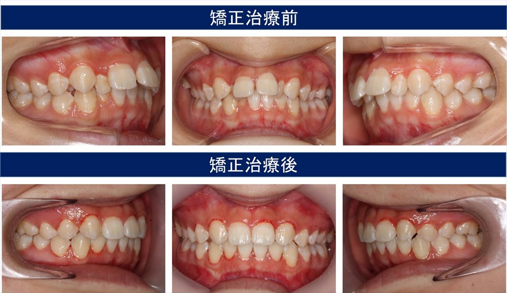 すきっ歯（空隙歯列）の治療例